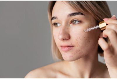 Best Anti-Acne Face Serum For Oily Skin In India By Riyo Herbs