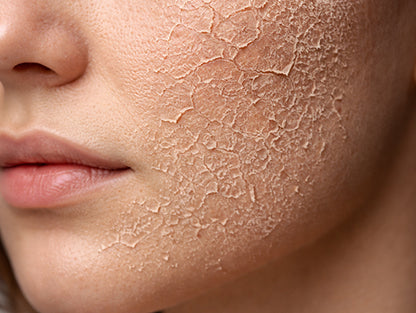 Dry Skin